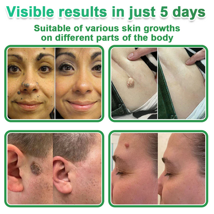 👉 80% OFF 😜 Hudros® 2-in-1 Microneedle & Hydrocolloid Patches | Helps Reduce the Appearance of Acne, Flat Warts & Skin Tags | Invisible Patches for Face & Body | 144 Pieces 😜