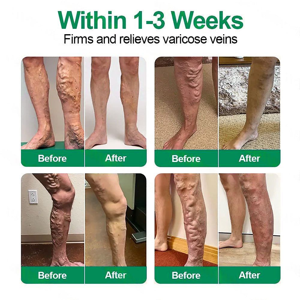 🌸𝐇𝐞𝐚𝐥𝐫𝐢𝐳𝐞® VenoEase Soluble Microneedle Patch⚡Instant Relief, Long-Term Results ⚡