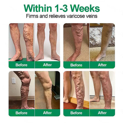 Healrize® VeinTarget Microneedle Patch💙Instant Relief, Long-Term Results