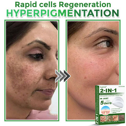 👉 80% OFF 😜 Hudros® 2-in-1 Microneedle & Hydrocolloid Patches | Helps Reduce the Appearance of Acne, Flat Warts & Skin Tags | Invisible Patches for Face & Body | 144 Pieces 😜