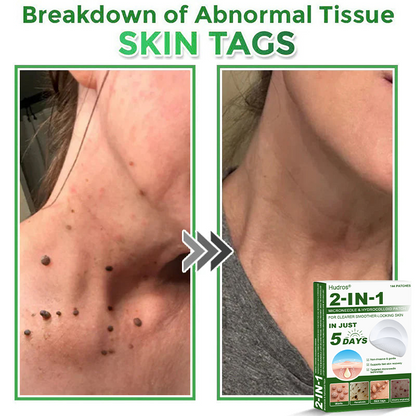 👉 80% OFF 😜 Hudros® 2-in-1 Microneedle & Hydrocolloid Patches | Helps Reduce the Appearance of Acne, Flat Warts & Skin Tags | Invisible Patches for Face & Body | 144 Pieces 😜